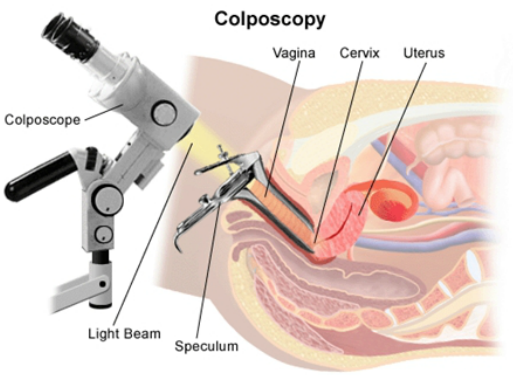 Minimally invasive procedure: Colposcopy