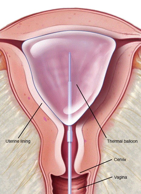 Minimally invasive procedure: Endometrial Ablation