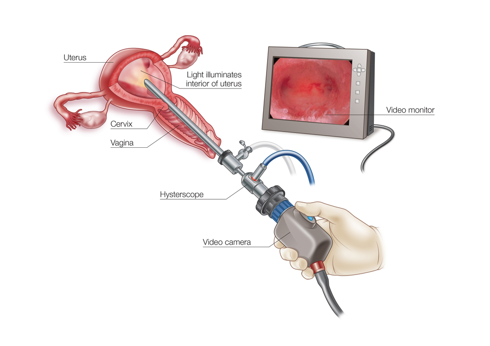 Minimally invasive procedure: Hysteroscopy