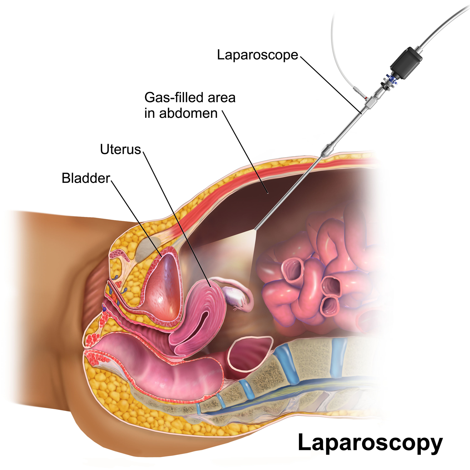 Minimally invasive procedure: Laparoscopy